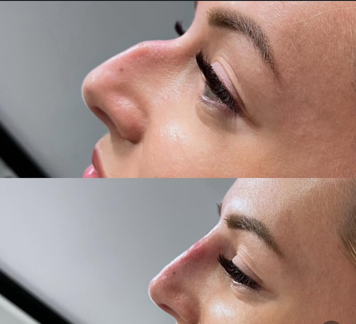 Non-Surgical Rhinoplasty Result
